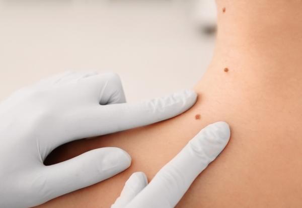 照護線上｜皮膚長肉芽、老人斑與突起物，是老化或癌症前兆？圖解8種常見皮膚瘤，這種最危險！