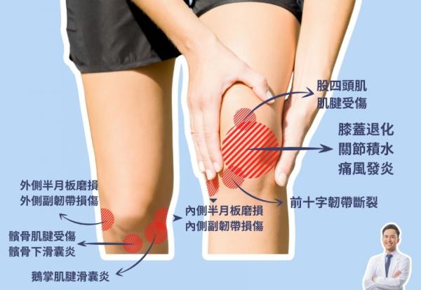 爬樓梯膝蓋痛、蹲下起身難，受傷部位不同！復健科醫師：2張圖看懂膝蓋痛位置與可能原因