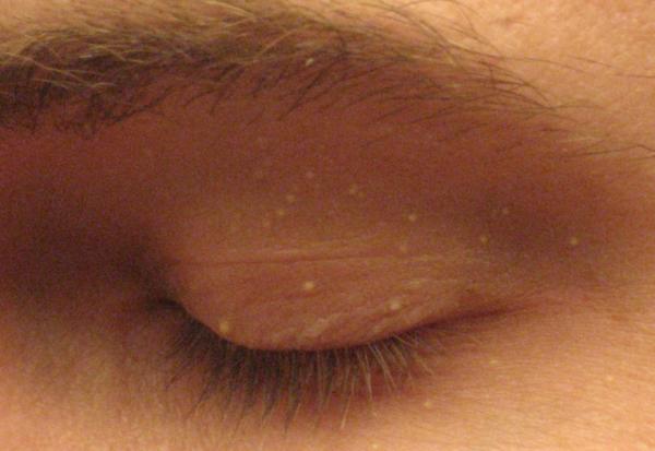 眼周附近有脂肪粒是疾病嗎？可以醫美或雷射嗎 ？ 醫師解析常見3種皮膚瘤處理