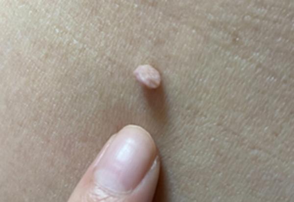 皮膚出現一顆顆肉芽會是健康警訊？四大疑惑一次看懂