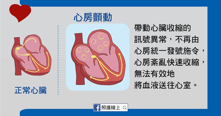 【照護線上】如何避免中風？檢查自己是否有「心房顫動」_img_3