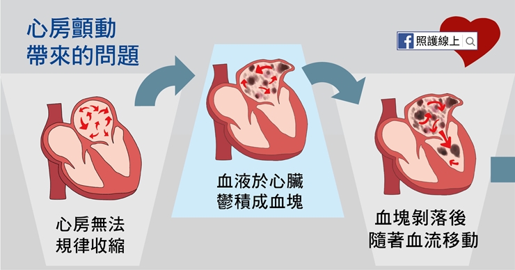 【照護線上】如何避免中風？檢查自己是否有「心房顫動」_img_4