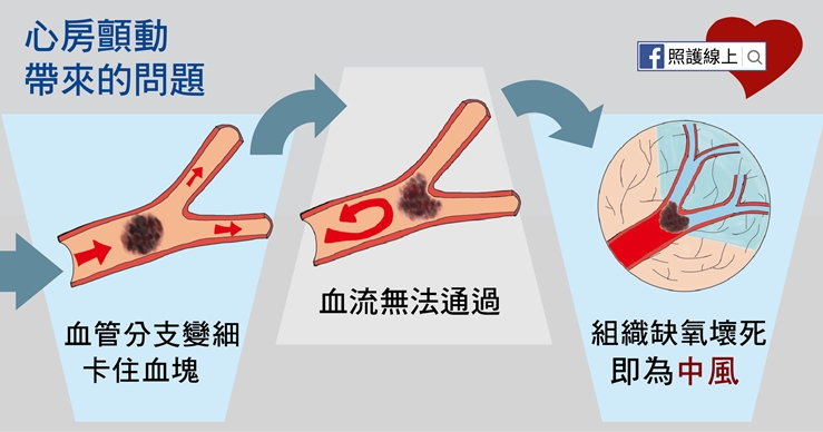 【照護線上】如何避免中風？檢查自己是否有「心房顫動」_img_5