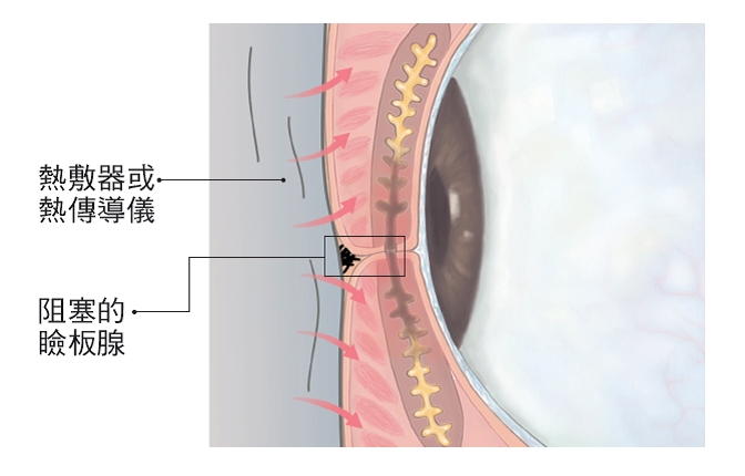 眼科醫師李文浩：減緩乾眼症狀，這樣熱敷才正確_img_2