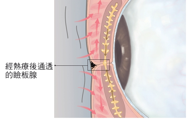 眼科醫師李文浩：減緩乾眼症狀，這樣熱敷才正確_img_4