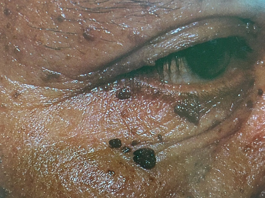 如何分辨曬斑、肝斑、老人斑？這樣預防，避免成為「郭台銘臉」_img_2