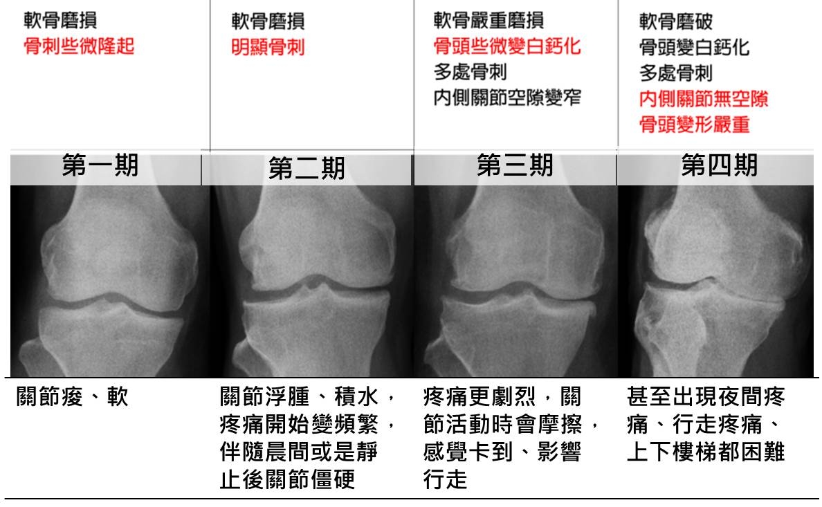 50歲後，3成患有膝關節退化！這樣鍛鍊「股四頭肌」，預防老後關節痛_img_3