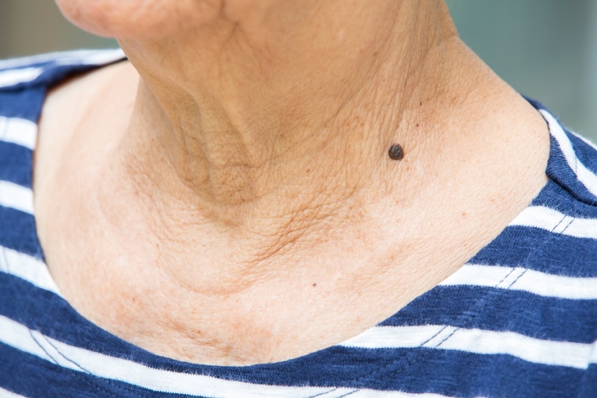 50歲是皮膚老化關鍵點!醫師:真正有效的除皺療程和保養品怎麼選?_img_2