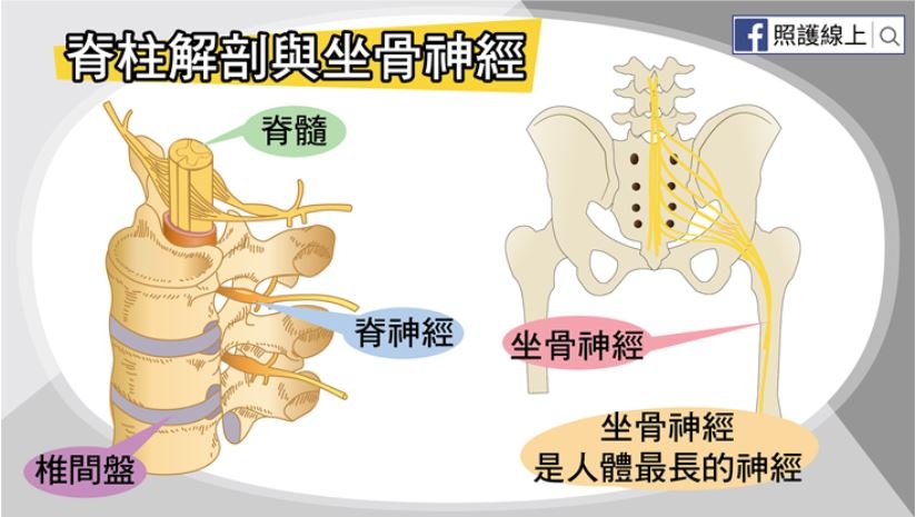 照護線上│50後易坐骨神經痛！屁股痛、腳麻、腿刺痛，在家做7件事預防與改善_img_1
