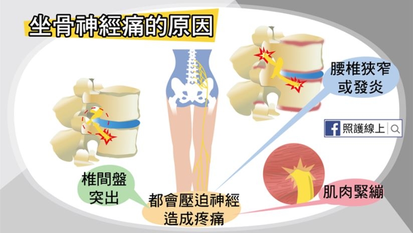 照護線上│50後易坐骨神經痛！屁股痛、腳麻、腿刺痛，在家做7件事預防與改善_img_3