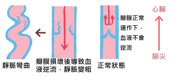 50歲要養成抬腳的習慣!超過一半人下肢靜脈曲張,做3動作預防_img_1