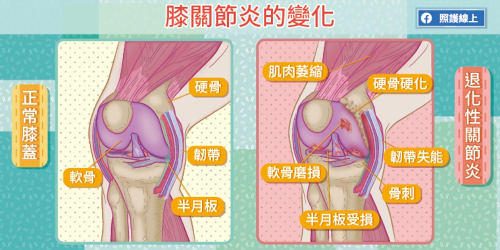 照護線上|改善膝蓋痛、防退化性關節炎,做這件事比吃藥有效_img_1