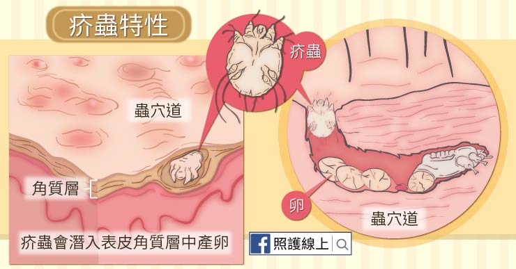 北市聯醫陽明院區疥瘡群聚感染！疥瘡是什麼？該如何預防與根除？_img_2