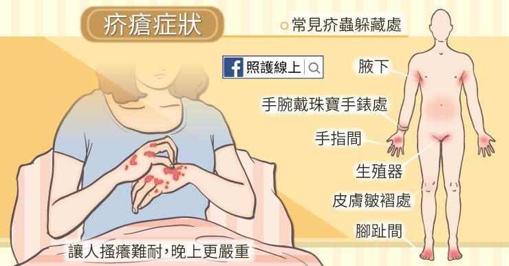 北市聯醫陽明院區疥瘡群聚感染！疥瘡是什麼？該如何預防與根除？_img_3