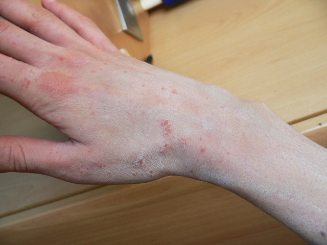 北市聯醫陽明院區疥瘡群聚感染！疥瘡是什麼？該如何預防與根除？_img_4