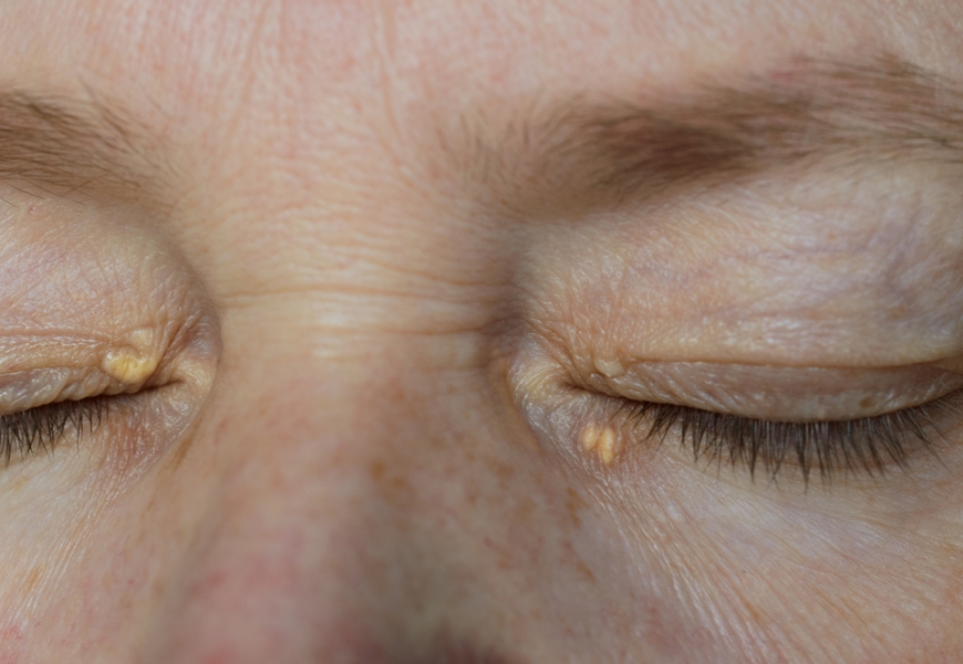 眼周附近有脂肪粒是疾病嗎?可以醫美或雷射嗎 ? 醫師解析常見3種皮膚瘤處理_img_2