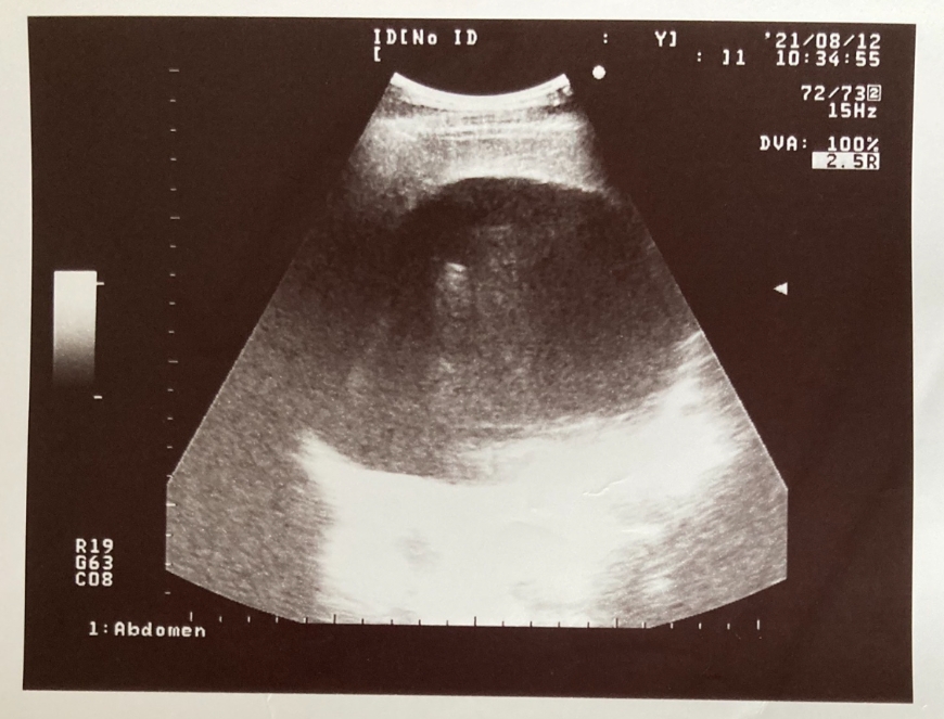 我要帶著14.5公分肝臟腫瘤,努力活下去!苦苓:從此,養成每天完成一件事的習慣_img_2