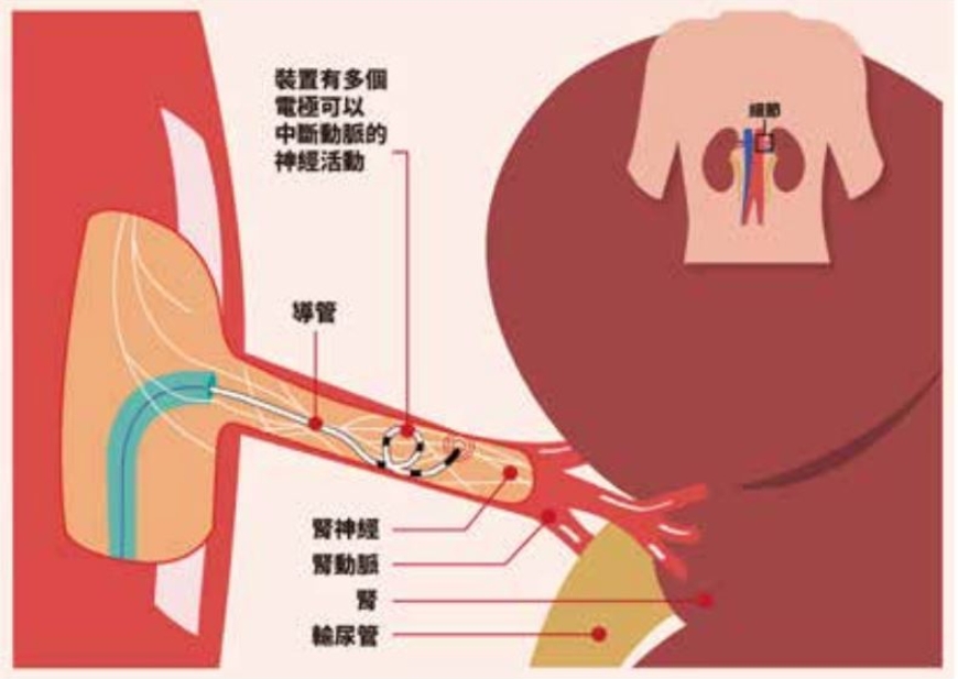 60歲以上血壓多少才正常?血壓藥要吃一輩子嗎?醫師:做好6件事降血壓,有機會停藥_img_1
