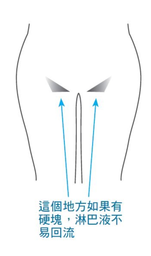 腳水腫、手臂粗，恐淋巴阻塞！每天這樣動手動腳，淋巴排毒要疏通重點2部位_img_5