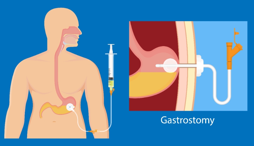 鼻胃管之外的選擇!癌友胃造口多年心得:不怕出門,能自理不麻煩家人_img_1