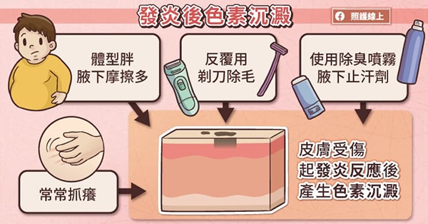 照護線上｜腋下變黑，可能是罹病徵兆！單純發炎後色素沉澱和黑色棘皮症，差別在哪？_img_1