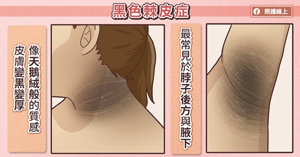 照護線上｜腋下變黑，可能是罹病徵兆！單純發炎後色素沉澱和黑色棘皮症，差別在哪？_img_3
