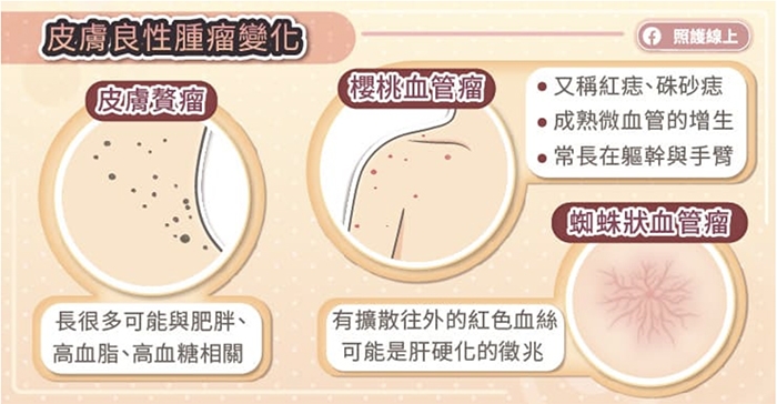 照護線上|皮膚長肉芽、老人斑與突起物,是老化或癌症前兆?圖解8種常見皮膚瘤,這種最危險!_img_1