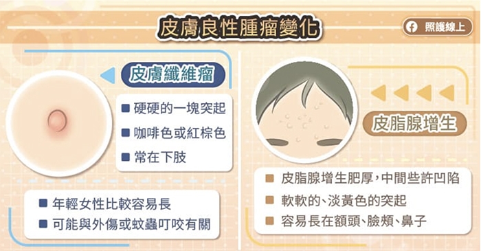 照護線上|皮膚長肉芽、老人斑與突起物,是老化或癌症前兆?圖解8種常見皮膚瘤,這種最危險!_img_2