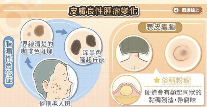 照護線上|皮膚長肉芽、老人斑與突起物,是老化或癌症前兆?圖解8種常見皮膚瘤,這種最危險!_img_3
