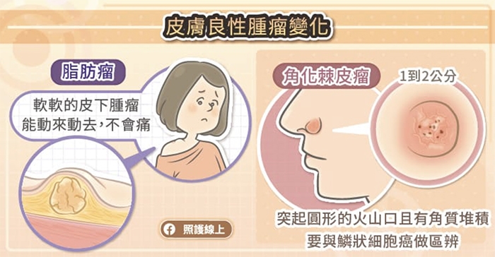 照護線上|皮膚長肉芽、老人斑與突起物,是老化或癌症前兆?圖解8種常見皮膚瘤,這種最危險!_img_4