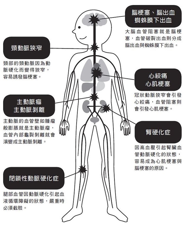 12個問題,測你的血管年齡幾歲?早晚兩組伸展幫老化血管回春,降心肌梗塞、腦出血風險_img_1