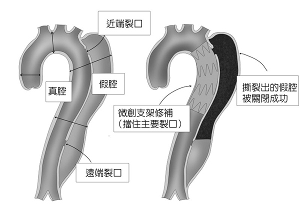 此為微創手術修復B型主動脈剝離過程示意圖。（圖片來源：《俠醫楊智鈞的50道心臟密碼》）
