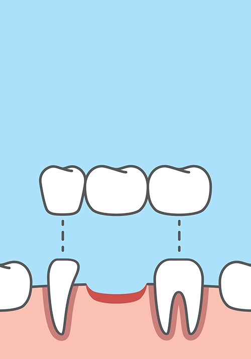 固定式假牙即大眾熟知的「缺1顆牙要做3顆牙」。