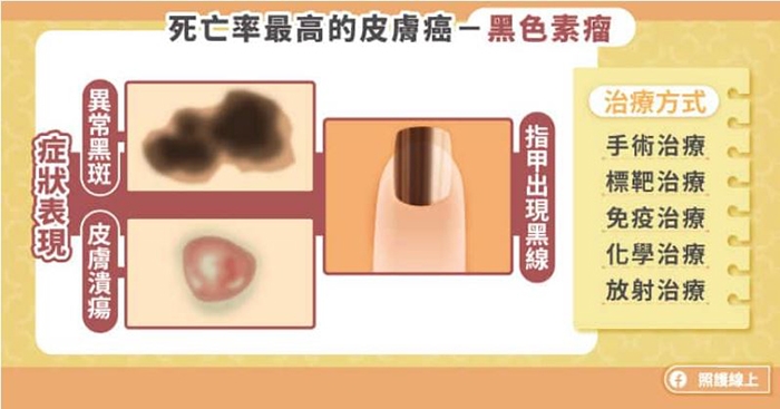 照護線上｜異常黑斑、指甲有黑線，恐是惡性黑色素瘤！ 死亡率最高皮膚癌有哪些症狀？_img_1