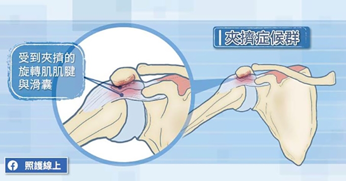 （圖片來源：照護線上）