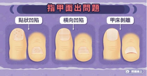 照護線上｜50後指甲有黑線快就醫！8種指甲變化反映身體哪裡有問題_img_1