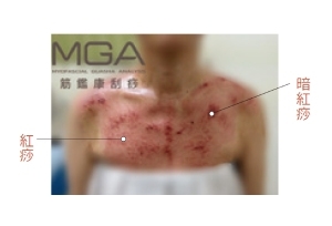 怕另一半生氣不敢亂說話,她常胸悶刮出滿滿紅痧!在家怎麼刮痧舒緩情緒、呼吸順暢?_img_1