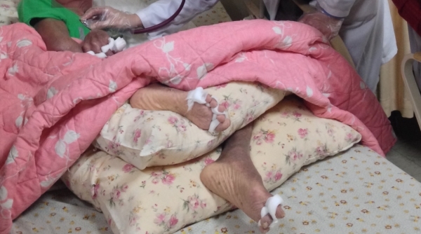 長輩進入失智症末期，大腦逐漸萎縮到運動皮質，導致四肢呈現攣縮狀。