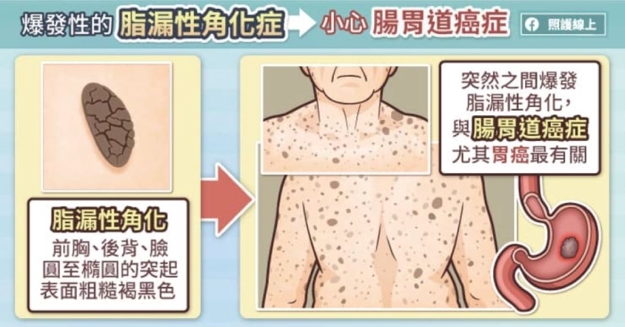 照護線上|老人斑突然增加很多,可能是腸胃道癌!5種跟重大疾病有關的皮膚病灶_img_2