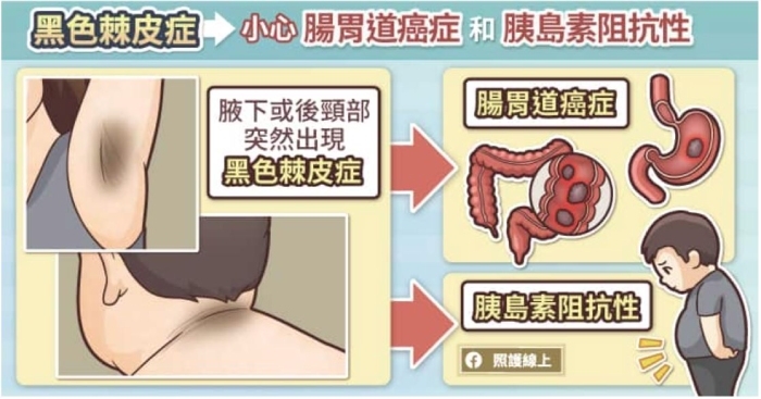 照護線上|老人斑突然增加很多,可能是腸胃道癌!5種跟重大疾病有關的皮膚病灶_img_3