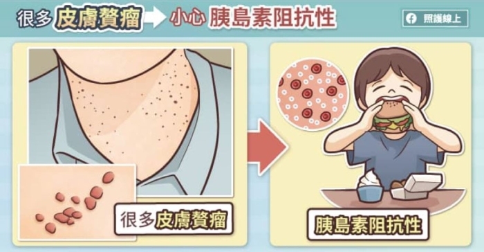 照護線上|老人斑突然增加很多,可能是腸胃道癌!5種跟重大疾病有關的皮膚病灶_img_4