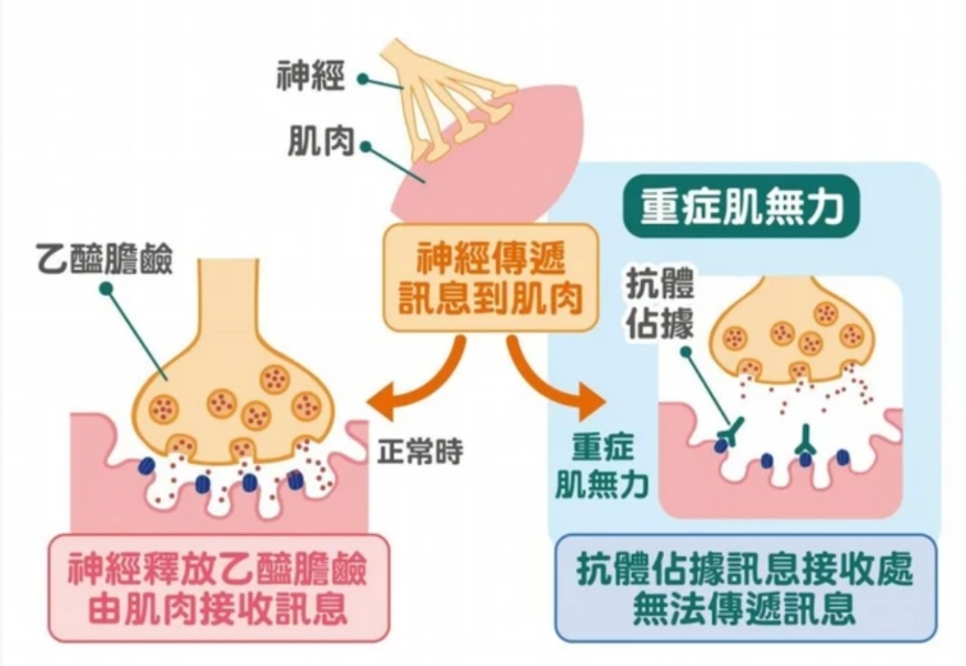 重症肌無力的致病原因，為神經無法有效將其訊號乙醯膽鹼（Ach） 傳導至接受器，所引起的肌肉無力症狀。（出自衛福部雙和醫院）