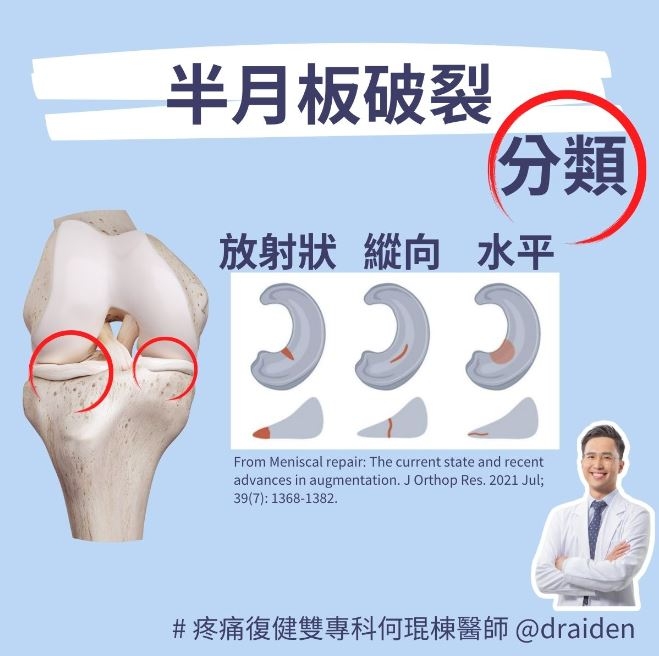 突然膝蓋痛、膝蓋腫、蹲不下去？膝蓋積水的4個症狀，如何治療趕快好？_img_3