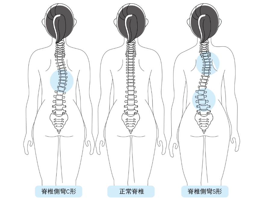 正常脊椎與脊椎側彎