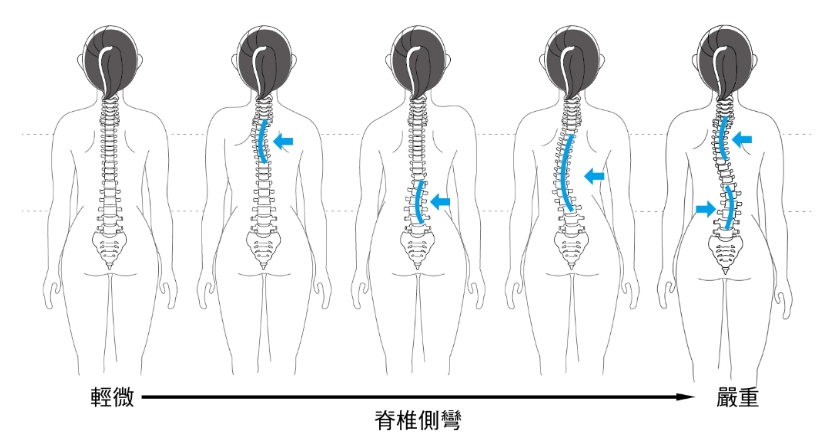 不同種類的脊椎側彎。