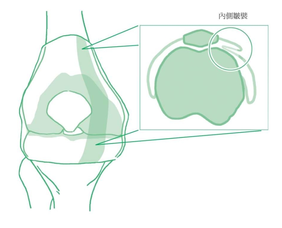 內側皺襞在關節腔中的位置。