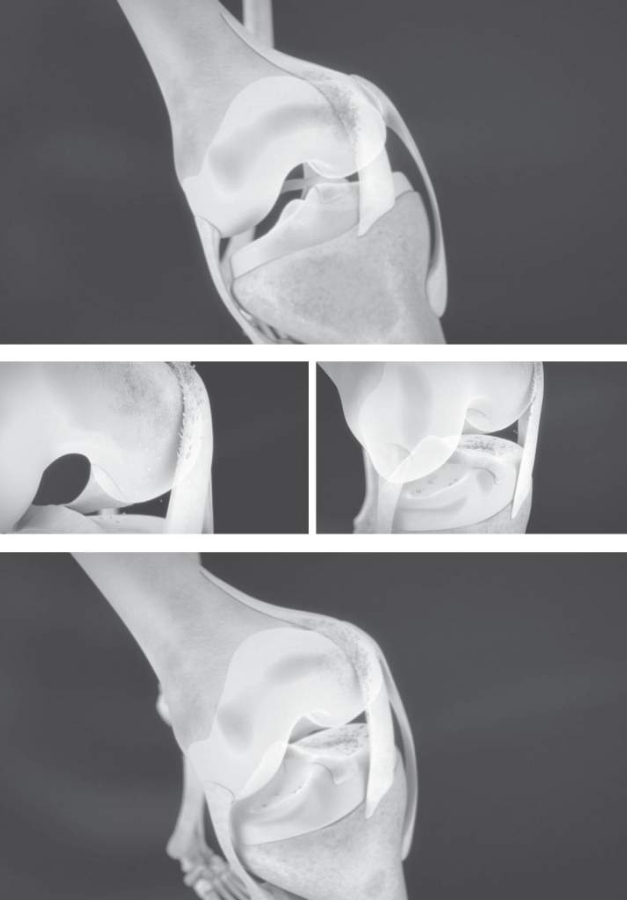 物理性磨損：膝蓋彎曲伸直時內側皺襞與股骨內髁互相摩擦。