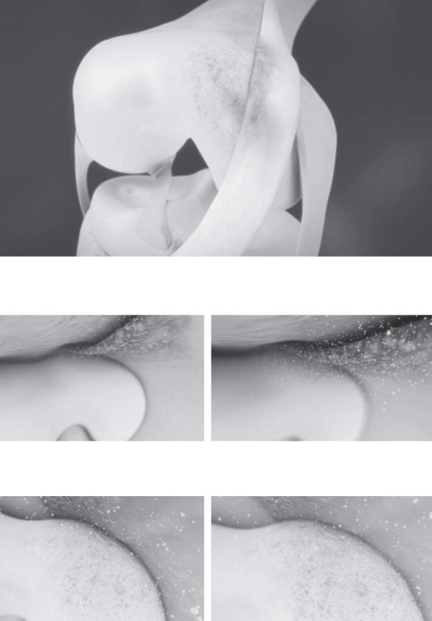 化學性破壞：內側皺襞發炎會釋放出有害的化學物質侵蝕關節軟骨。