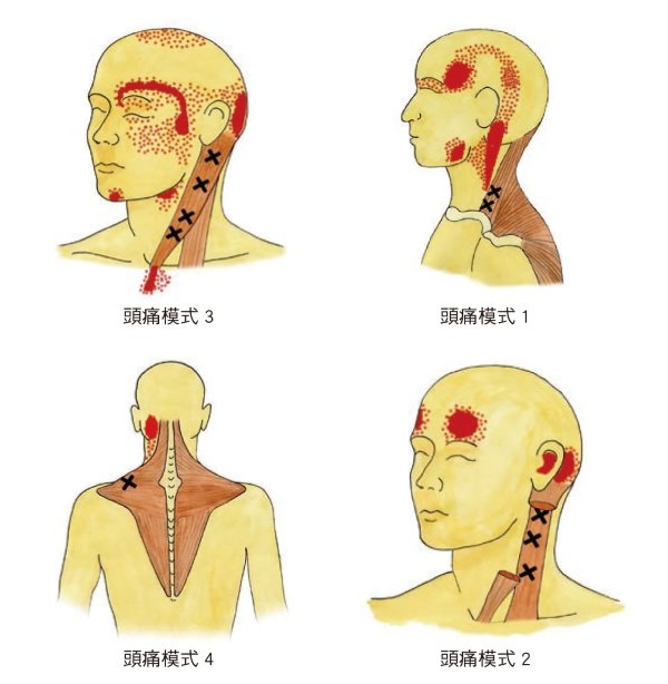 偏頭痛有4種不同類型，由胸鎖乳突肌或斜方肌的不同緊繃模式引起。請檢視這4張圖，看看是否能辨認出是哪種紅色的偏頭痛模式困擾著你。